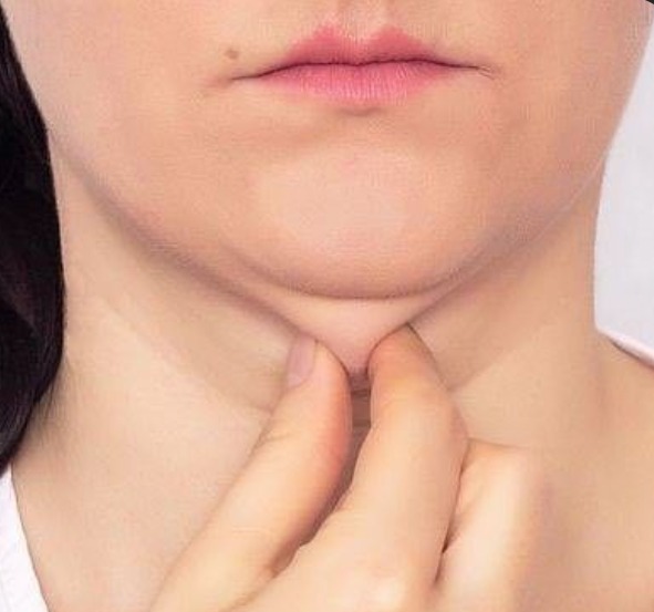 double-chin